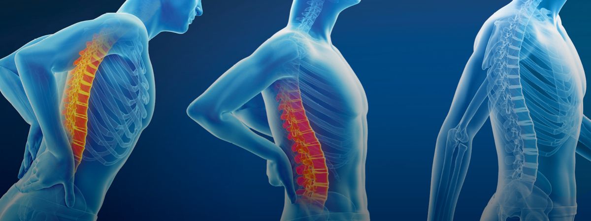 medical diagram of back pain stages